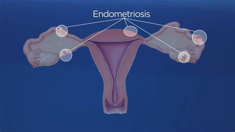 Endometriosis Why Canadian Women Are Flocking To A Clinic In Bucharest
