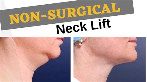 Non Surgical Neck Lift Permanent Results Of Skin Secrets By Dr