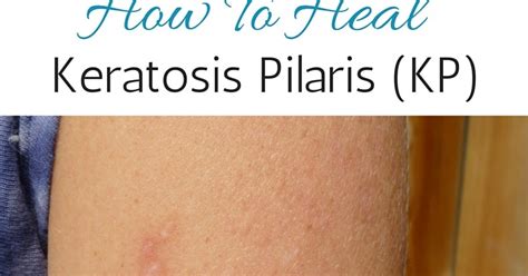 Pure And Simple Nourishment How I Healed My Keratosis Pilaris Kp