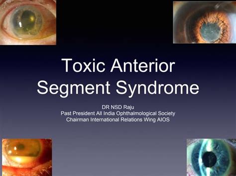 Causes Of Toxic Anterior Segment Syndrome Ppt