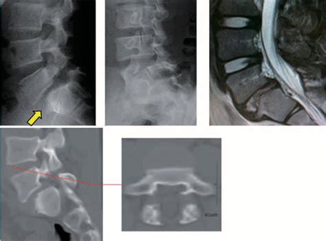 Pdf The Reduction And Direct Repair Of Isthmic Spondylolisthesis