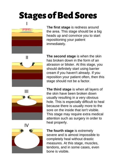 Stages Of Bed Sores Chart Poster By Caregiverology In Bed Sores Medical Ultrasound Soreness