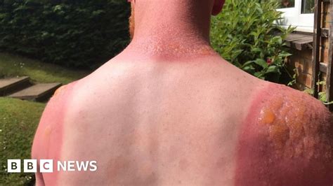 Heatwave Leaves Edinburgh Gardener With Second Degree Burns Bbc News