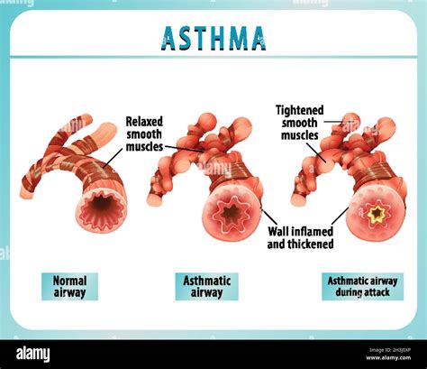 Bronchial Asthma Diagram With Normal Airway And Asthmatic Airway