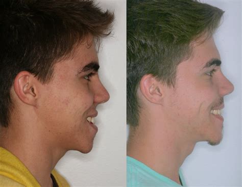 Orthognathic Surgery Drbeckmann