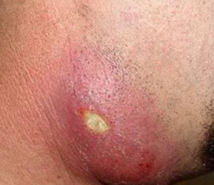When you have recurrent cases are sometimes called folliculitis. Ingrown Hair Cyst - Pictures, Removal, Treatment, Causes ...