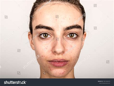 Beautiful Young Girl Problematic Skin Acne Stock Photo 1091494616