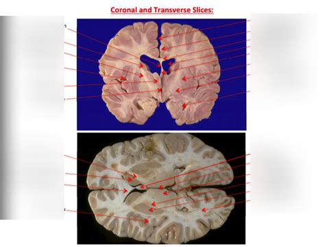 Coronal And Transverse Brain Slices Diagram Quizlet