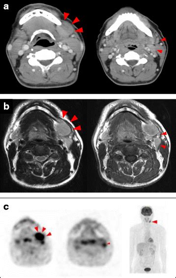 Diagnostic Dilemma Of Igg4 Related Primary Localized Cervical