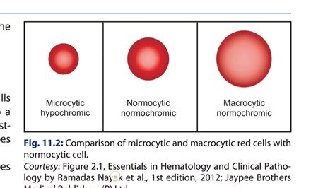 Comparision Of Micro And Macrocytic Red Cells With Normocytic Red Cell