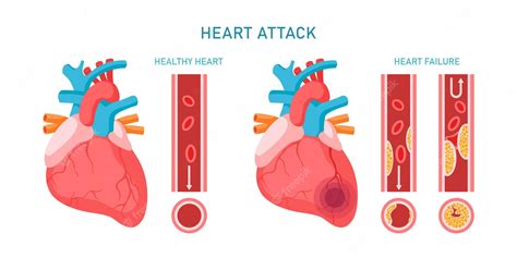 Infografía De Ataque Cardíaco Y Enfermedades Cardiovasculares