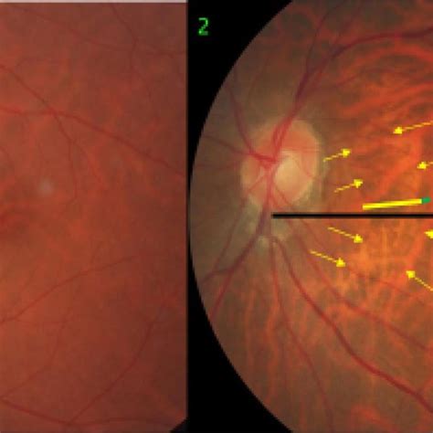 Fundus Photographs Of A Highly Myopic Eye Taken With An Interval Of 10
