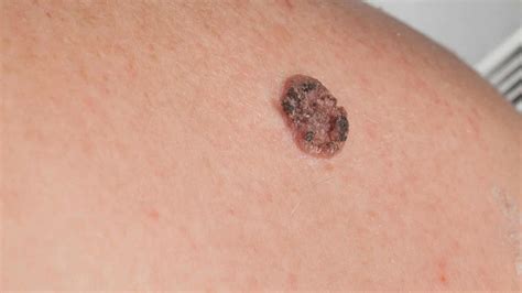 Squamous Cell Carcinoma Causes Symptoms And Treatments
