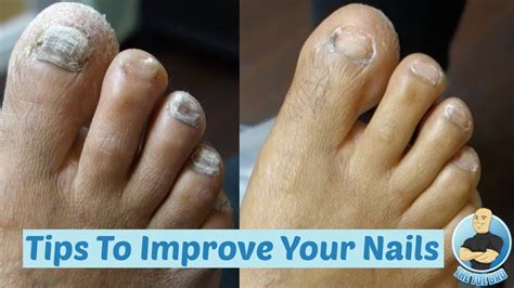 Diy At Home How To Make Your Thick Toenails Look Better Cutting Of