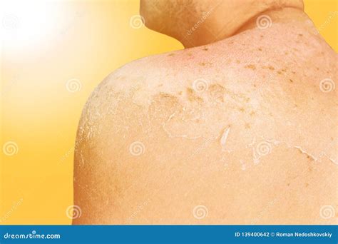 Sunny Sunburn Concept Back Of A Man With Skin Burned In The Bright Sun