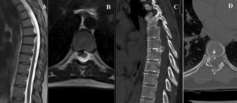 Patient 5 T7t8 Intervertebral Disc Ossification And Herniation