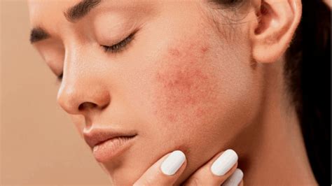 Ayurvedic Treatment Of Skin Diseases Permanent And Effective
