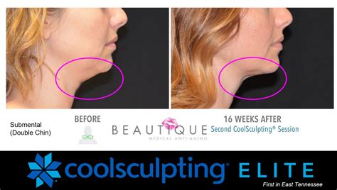Whats The Difference Between Coolsculpting In Knoxville And Coolsculpting Elite Beautique
