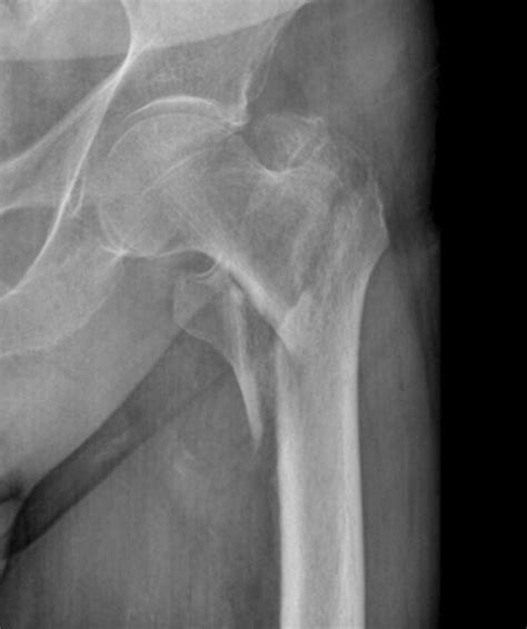Radiograph Of The Left Hip Obtained On The Day Of Admission Displaying