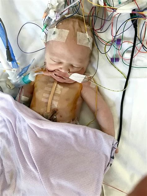 Powerful Pictures Show Strong Baby Recovering From Open Heart Surgery Less Than One Day Old