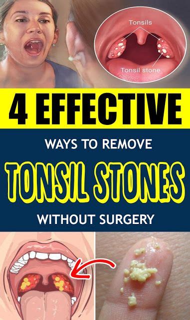 4 Effective Ways To Remove Tonsil Stones Without Surgery Wellness Know