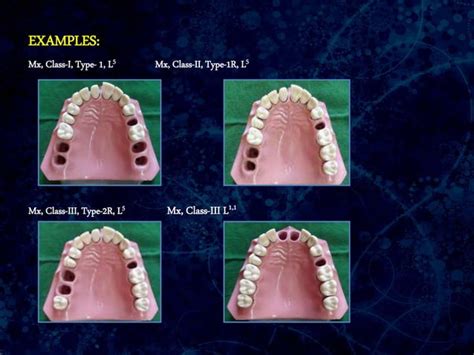Classification Of Partially Edentulous Arches Ppt