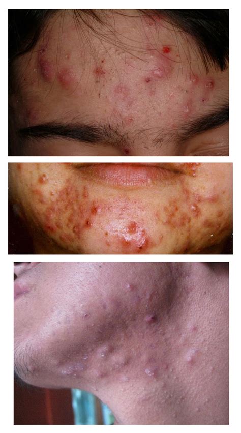 How To Recognize What Kind Of Acne You Have Innate Skin