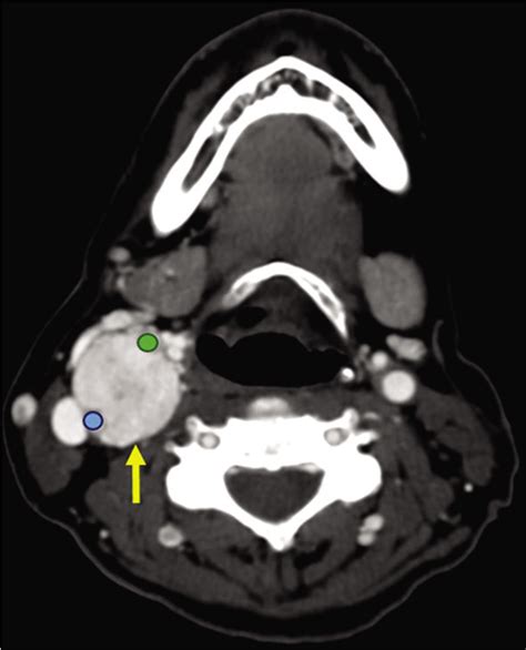 A Case Of Carotid Body Tumor With Perineural Tumor Spread Along The