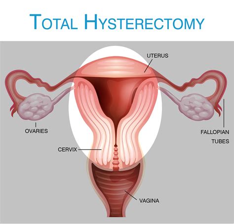 What Is A Hysterectomy