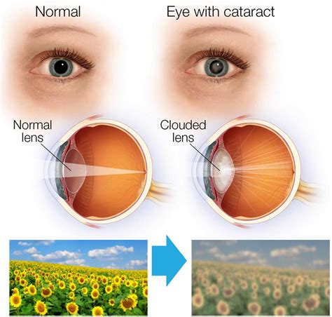 Glaucoma And Cataracts Glaucoma Associates Of Texas