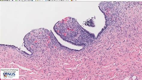 Ovary Serous Cystadenoma Microscopy Talking Slide Youtube