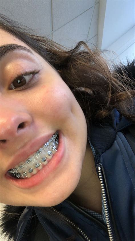 Follow My Instagram For More Pins Like This Thepageforbaddies ️ Braces Colors Cute Braces