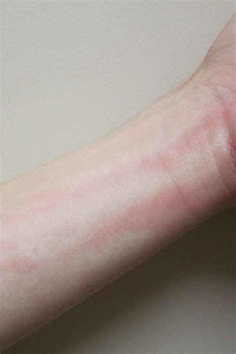 Lymphangitis Causes Symptoms And Pictures