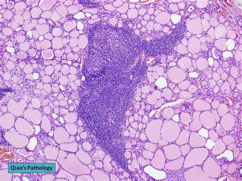 Qiaos Pathology Chronic Lymphocytic Thyroiditis Hashimo Flickr