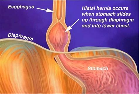 Healthitis Hiatus Hernia Hiatus Hernia Hernia Symptoms Health Info