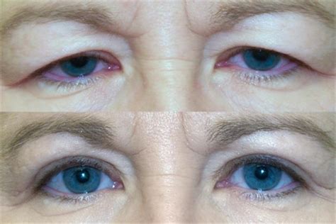 Cosmetic And Reconstructive Surgery Of The Eyelids Orbits And Tear Ducts