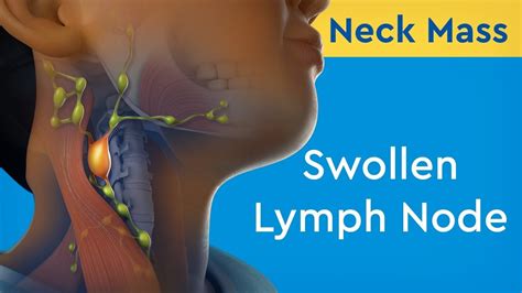 Should You Exercise With Swollen Lymph Nodes Online Degrees