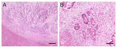 Histology Of Liver Sample 1 Adenocarcinoma Metastases A Sharply