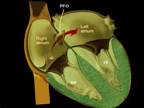 Catheter Management Of Patent Foramen Ovale Treatment Management