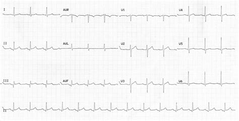 Ecg ndings in patients with acute viral myocarditis are highly variable. Myocardial Ischaemia • LITFL • ECG Library Diagnosis