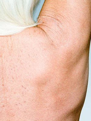 Mostly pain is high in the morning after waking up. Cyst on Shoulder: Skin Cysts, Lumps & Bumps | Everyday Health