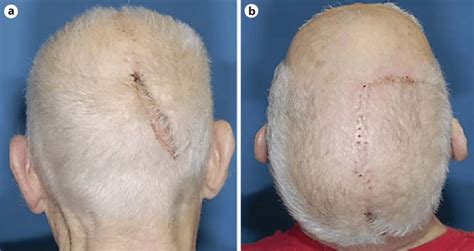 Patient With No Subsequent Erosion After A Rotational Scalp Flap