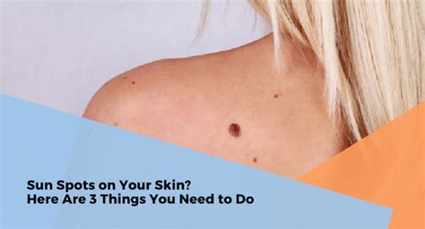 Sun Spots On Your Skin 3 Things You Need To Do