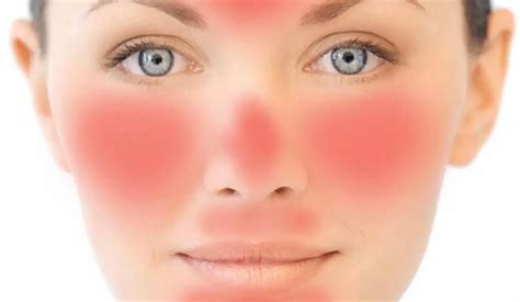 Redness Around The Nose Causes Symptoms Diagnostic Tests And