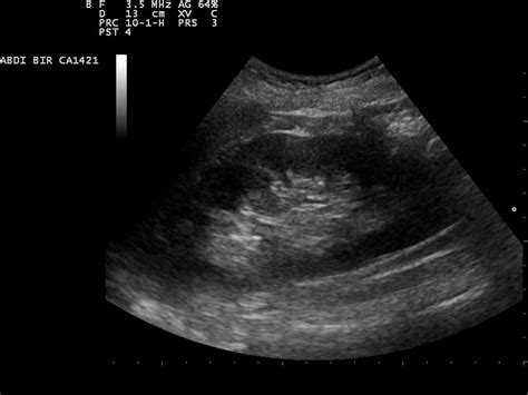 How to prepare for a renal ultrasound, explained in detail later. File:Kidney ultrasound 110322105841 1059470.jpg