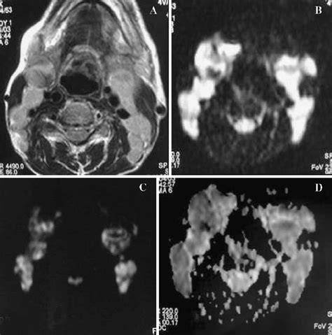 A D Metastatic Cervical Lymph Node A Axial T2 Weighted Mr Image