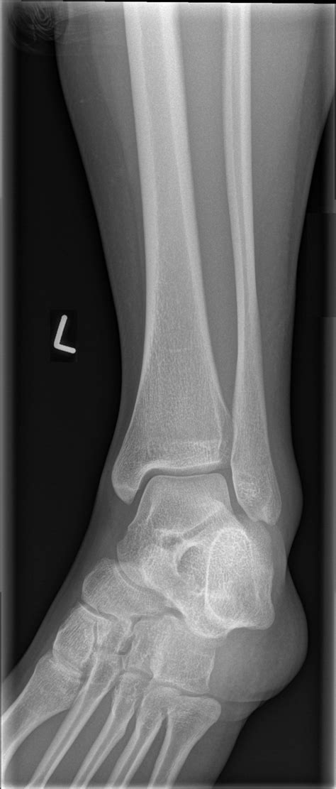 Normal Ankle Image