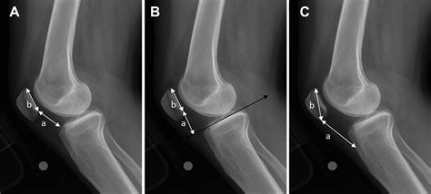 Medial Patellofemoral Ligament Reconstruction Reduces Radiographic