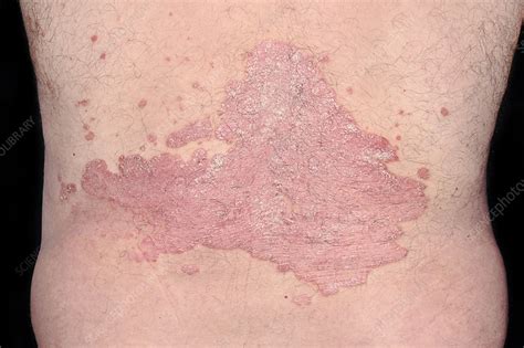 Psoriasis On The Lower Back Stock Image C0401009 Science Photo