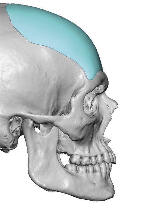 Plastic Surgery Case Study Custom Forehead Augmentation In Male